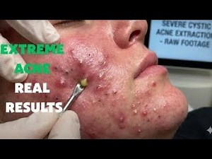 👉 SEVERE ACNE EXTRACTION ⚠️ GRAPHIC SKIN CONTENT | SAC DEP SPA OFFICIAL
