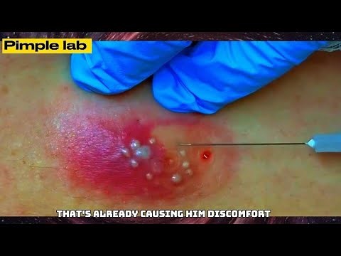Infected Epidermal Cyst Drainage and Removal || Pimple lab