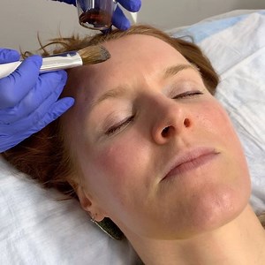 Let the peeling begin. PCA Sensi Peel gives the best result for sun damaged skin, acne, hyperpigmentation and that fresh glow. Peel up to 5 days. We have a full variety of PCA chemical peels. Book your appointment today! (410)768-0262 www.womenshealthofmd.com Que comience el pelado. PCA Sensi Peel brinda el mejor resultado para la piel dañada por el sol y ese brillo fresco. Pelar hasta 5 días. Tenemos una variedad completa de exfoliaciones químicas PCA. Reserve su cita hoy! (410)768-0262 www.wom