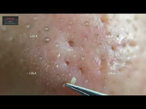 Most Relaxing, Satisfying, and Enjoyable; Pluck Acne with Tweezer 07