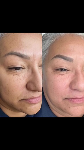Hey everyone! 👋🏼 Have you been thinking about getting your eyebrows done but hesitant because of a bad experience in the past? I recently had a client who had Microblading done a while back, but unfortunately, the color turned blue and some spots were too dark. But after getting her eyebrows redone, she is absolutely thrilled with the results! 😍If you've been in a similar situation, don't wait any longer to fix it! My client couldn't be happier with the outcome, and I would love to help you a