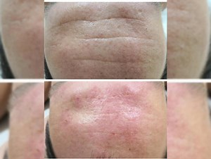 Relleno Facial PLASMA GEL 🤗😊 Rejuvenecimiento de rostro con tu propio Plasma!! 100 % Seguro , hermoso y de resultados inmediatos! ✔️ 1 Sesion Mensual , en total 3 sesiones (es lo recomendado) Incluye: Hidratacion facial , serum , mascarillas, Fototerapia para estimular colágeno, radio frecuencia tensora. 🎊 Regalía Cóctel Vitaminas Faciales 🎊 1 Sesión ₡45.000 mil colones Pax de 3 Sesiones ₡98.000 😱😱🎊🎊 Te esperamos 🥰🥰 | Santa Belleza Estetic