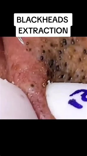 #blackholeremoval #satisfying #cleaningtiktok #cleaning #blackheadsremoval #blackheads #blackhead #tiktokusa #toppimples #pimplepop #clipvideotiktok #peeling #ingrownhair #relaxing #satysfying #relaxingvideos #pimple #foryoupage #foryou #tiktokindia #pimplepatches