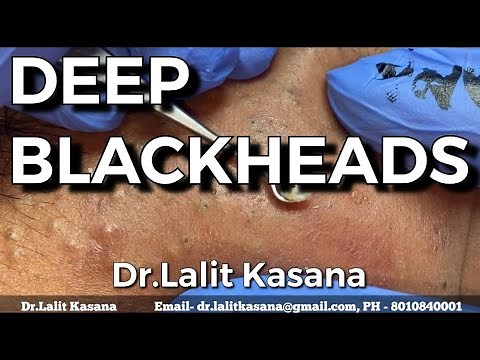 DEEP OLD BLACKHEADS REMOVAL BY Dr.Lalit Kasana (24 Jan. 2020)