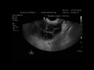 Ultrasound Guided Transvaginal Oocyte Retrieval