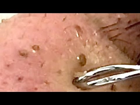 The blackheads on the nose are cleaned up.