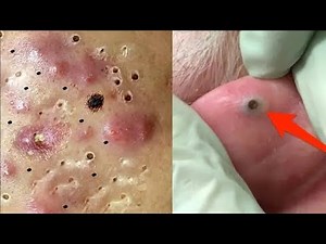 Ear Blackhead professional extraction - Full Video of blackhead removal on ear