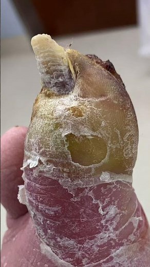 TOE AMPUTATION FROM INFECTION 😳🤯 #shorts #diabetes