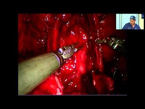 Full Narrated Robotic-Assisted Prostatectomy | Global Robotics Institute | AdventHealth