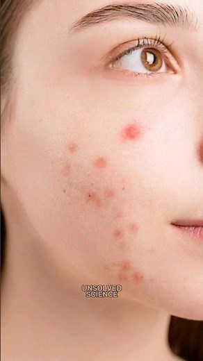 How Pimples occur #science #sciencefacts