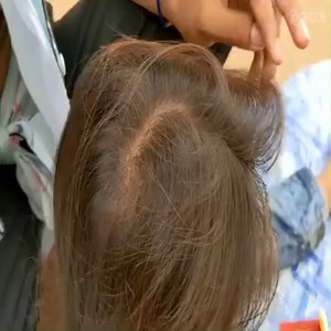 Getting out all lice from short hair | Natural Lice