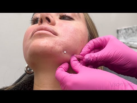 Build Collagen and Smooth Skin with VSoft Smooth PDO Threads