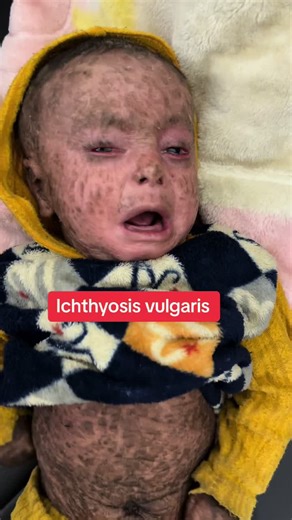 Understanding Collodion Baby: Causes, Treatment, and Awareness