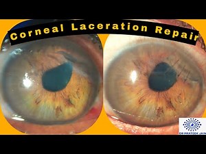#119 Corneal laceration repair | tips on corneal suturing ‪@DrPrateekJain_Eye‬