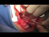 A to Z Steps of Repairing Total Annamalous Pulmonary Venous Return • Video • MEDtube.net
