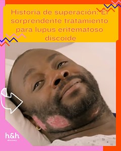 Descubre el asombroso éxito en el tratamiento de una persona que vive con lupus eritematoso discoide | Discovery Home & Health