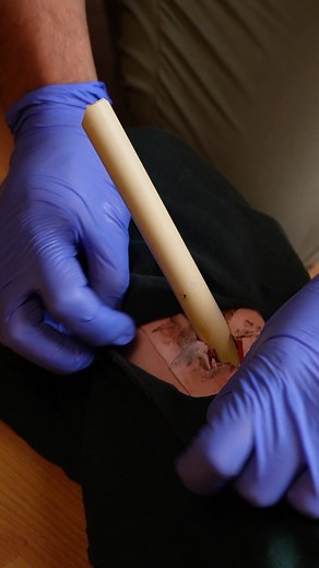 Cómo manejar una fractura expuesta correctamente