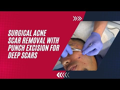 SURGICAL ACNE SCAR REMOVAL WITH PUNCH EXCISION FOR DEEP SCARS | Dr. Jason Emer