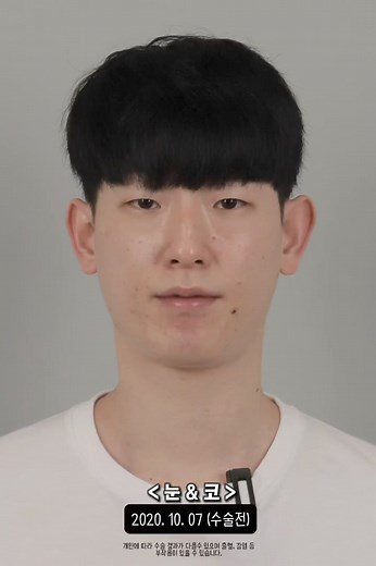 Сэтгэл ханамж 100 хувь #idhospitalkorea #koreanplasticsurgery...