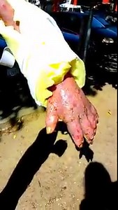 Aftermath Of Shooting Up Heroin With Dirty Needles... | The Junkies Bible