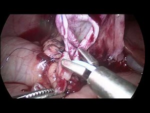 Laparoscopic Pyeloplasty in a 2-year-old Child • Video • MEDtube.net