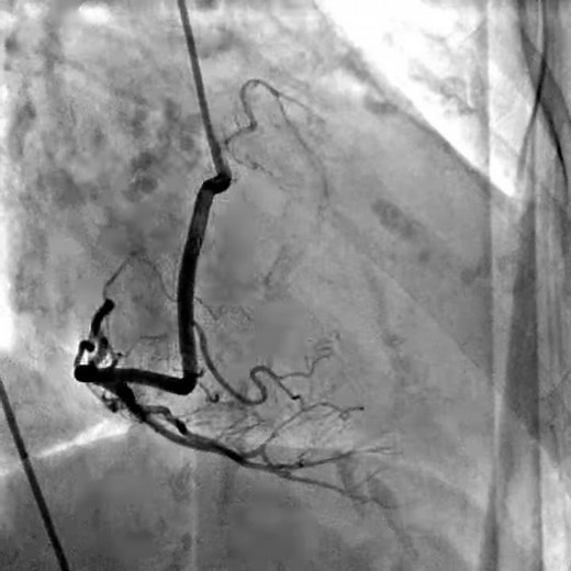 Coronary angiography indications