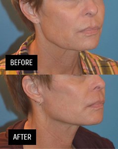 It’s MACSlift and facelift season here at UFP and we love seeing everyone’s results! This patient underwent an in-office MACSlift (mini facelift) by Dr Henstrom to lift the lower face and neck She looks completely natural, refreshed and rejuvenated #transformationyoucantrust #faceliftspecialist #slcplasticsurgeon #minifacelift #minifaceliftslc #macsliftmacsliftutah | Utah Facial Plastics | Facebook