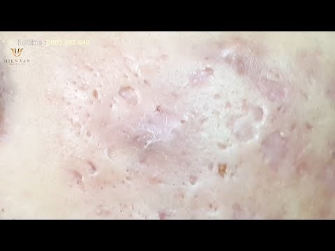 Extraction "acne" at hien van spa|360| Cao Xuân Thắng