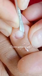 2K views · 33 reactions | Small toenail dryskin removal,, #ingrowntoenail #pedicure #fbpost #satisfying #dryskin | Rowena Garcia Vargas | Facebook