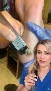 10K views · 44 reactions | That ending is satisfying! #podiatrist #podiatry #cornremoval #removal #callusremoval #oddlysatisfying #dermatology #pedicure #doctor #doctors #doctorsoftiktok #medicine #medical #medicalhumor #medicalvideos #surgery #nurse #nurses #podiatry #podiatrist #podiatric #surgeon #surgeons #footsurgeon #healthcare #scrublife  drchenha | Footdocdana | Facebook