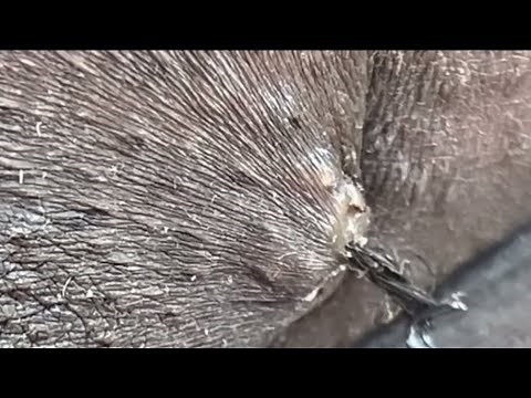 The longest ingrown hair removal 🤮🤮🤮🤮🫢🫢🫢🫢