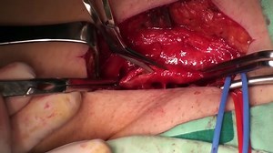 Fem Pop Bypass with tube graft - HDH MEDICAL Ltd.