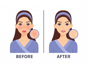 Couperose. Penyakit Kulit, Masalah pada Wajah Wanita Kartun Cantik...