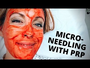 Microneedling With PRP - Full Microneedling Facial Review