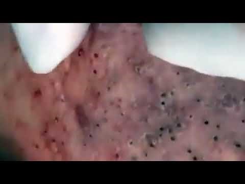 Satisfying viral acne Millions blackheads new 2021 #001