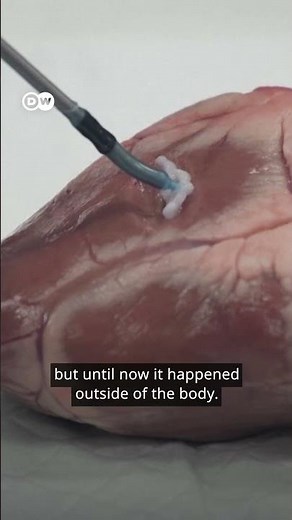 Tiny robot 3D prints inside human bodies