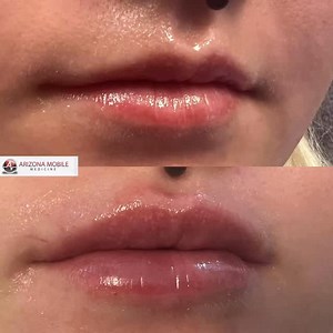 Before/after a lip augmentation! Lasts 6-9 months Costs $599 Shuree...