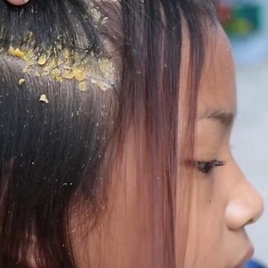 Picking Dandruff Worms On Hole Scalp By Beautiful Girl's Hand #HUGE FLAKE #DandruffBigFlakes #dandruffremoval #dandruffshampoo #dandruffproblems #dandrufftreatment | FreeQgame