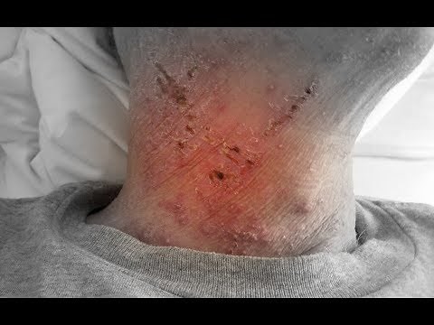 Treatments for HPV-Related Oropharyngeal Cancer: Proton Therapy (Radiation) and Chemotherapy