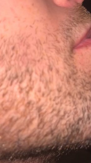 Satify !! Pulling out my husbands beard pili multigemini hair #pick #plucking #asmr #beard #multigemini #sebaceousfilament #beardhairplucking #satisfyingvideos #extractions | Lucia Martini