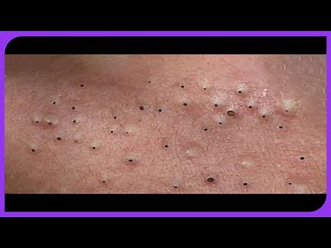 . Satisfying Blackheads Removal: Pimple Popping Blackheads on Skin 2024