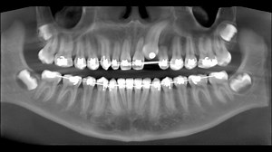 Case Study with Dr. Lea AI Matny 120KV: CBCT scan acquisition is not a “one size fits all.” There are various clinically applied imaging protocols that can impact image quality. Increasing the tube voltage (kVp) can lead to decreased image noise, more image uniformity and increased SNR. This is a medium field of view taken at 120kv on the CS 9600. #CarestreamDental | Carestream Dental | Facebook