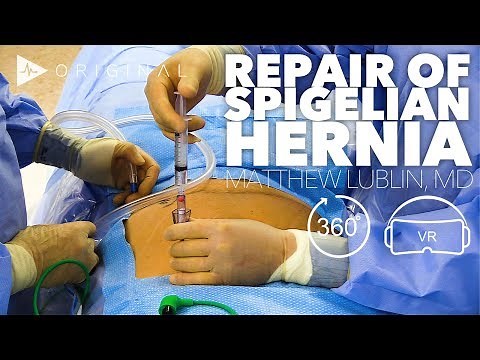 Robotic Spigelian Hernia Repair - Dr. Matthew Lublin