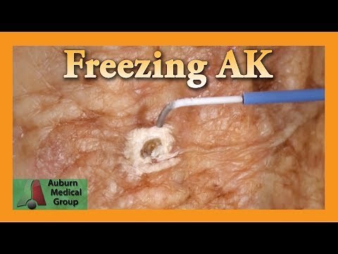 Freezing Hand Actinic Keratosis with Liquid Nitrogen | Auburn Medical Group