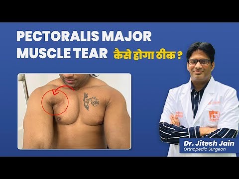 Pectoralis Major Muscle Tear कैसे होगा ठीक ? Bench Press Injury | Dr Jitesh Jain