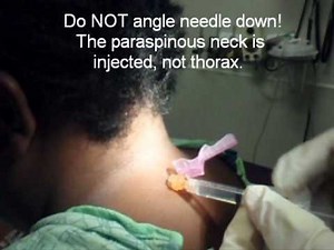 Cervical Injection for Headaches