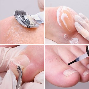 12K views · 162 reactions | Get beautiful feet by treating your cracked heels and toes | Lilyon | Facebook