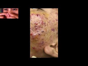 Infected Skin TONS of Blackheads, Whiteheads, & Cysts All Over Face!