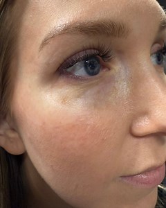 Check out this amazing before-and-after transformation! ✨ This is the power of @ultraceuticals B² Hydrating Eye Masks—just one use delivers real, visible results! Book a facial through this link: https://www.phorest.com/salon/salonspawin to see the transformation on yourself! __ Salon Spa W • Des Moines Salon • Des Moines Spa • Heart your stylist • Skincare • Facial • Ultraceuticals • Hydration Mask • Glowing Skin • RVR90 | Salon Spa W | Facebook