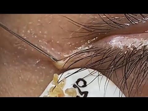 Deep blackhead extraction Cystic acne & pimple popping #95